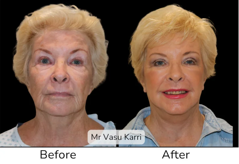 Facelift Patient 5 View 1